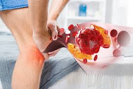 Gambar artikel ASAM URAT