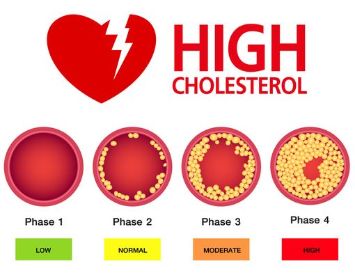 Gambar artikel KOLESTEROL TINGGI